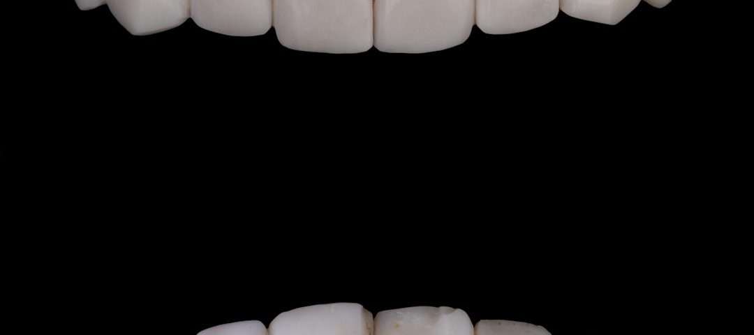 composite bonding
