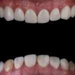 composite bonding