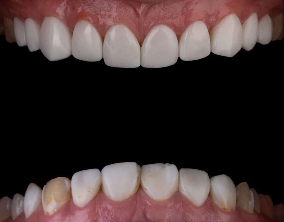 composite bonding
